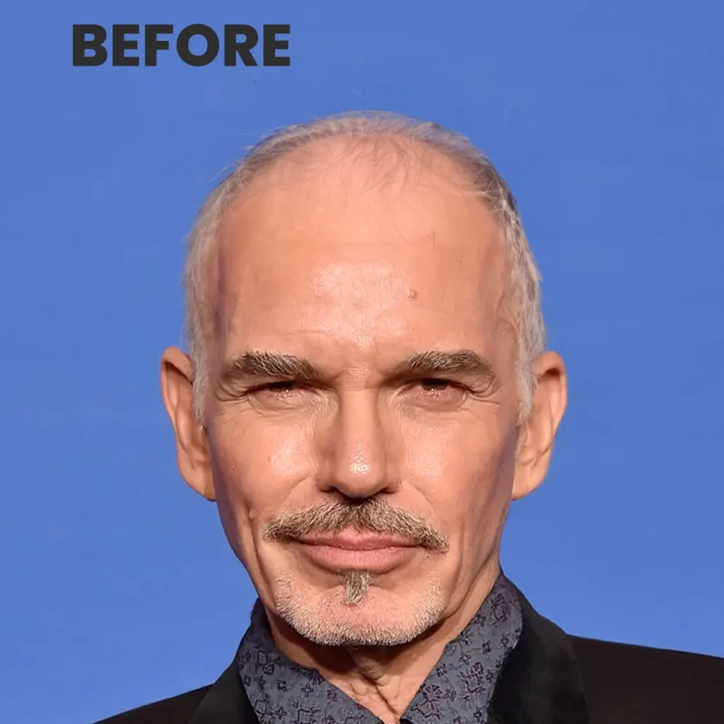 Billy Bob Thornton Hair Transplant Simulation