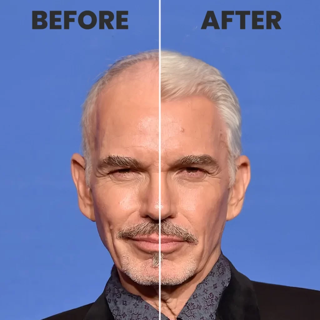 Billy Bob Thornton Hair Transplant Simulation