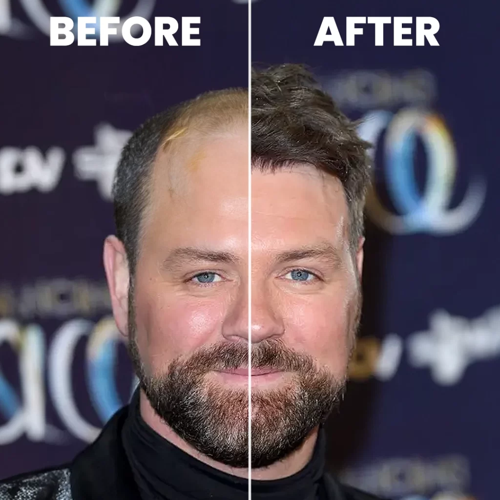 Did The Westlife Star Brian McFadden Restore His Hairline 