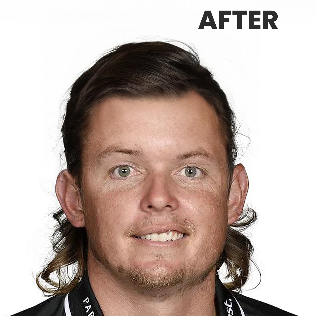 Cameron Smith’s Next Look: Imagining a Hair Transplant Transformation