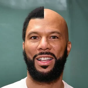 Common hair transplant result