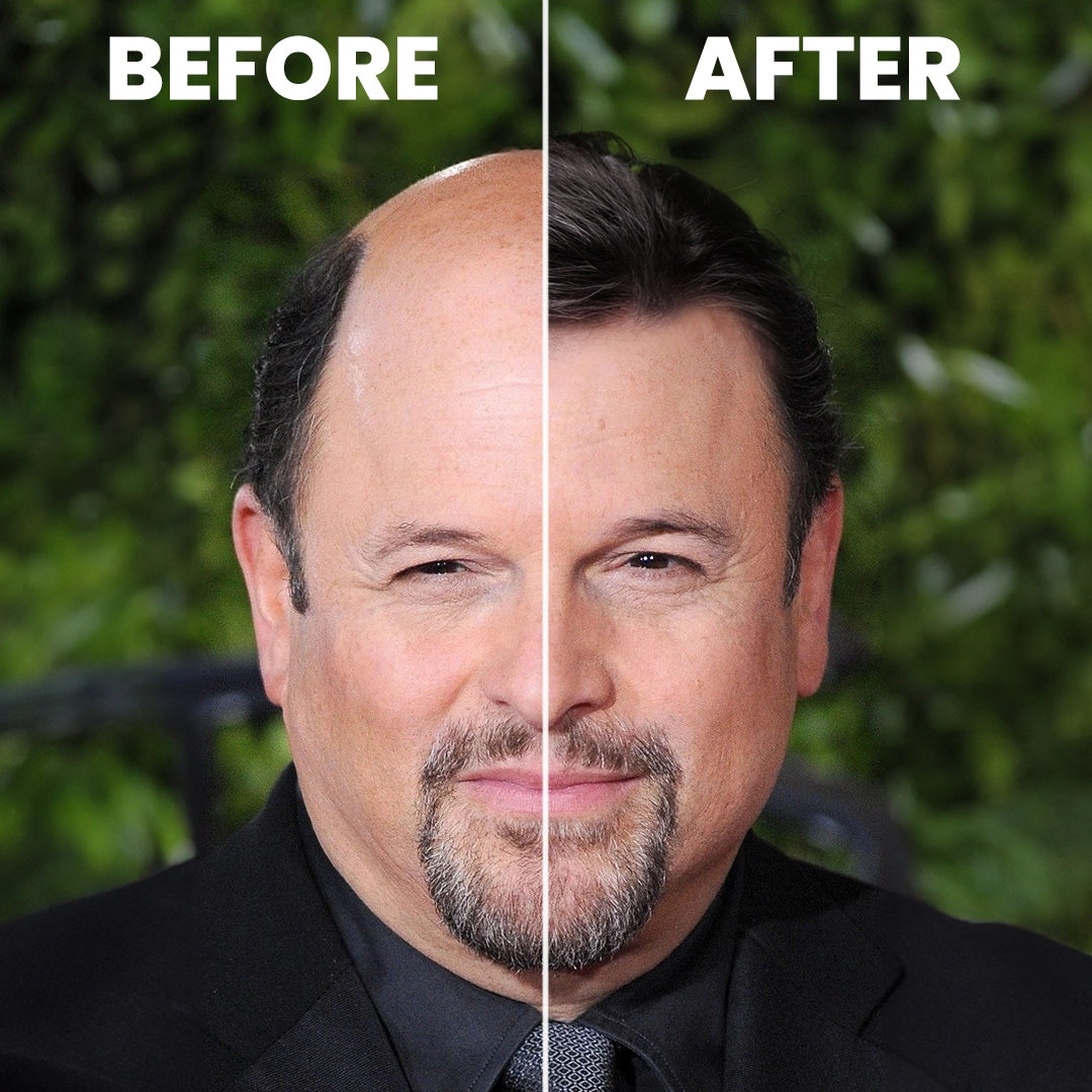 Jason Alexander Hair Transplant Simulation