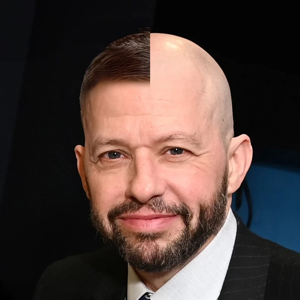 Jon Cryer With Hair | Amazing Hair Transplant Result