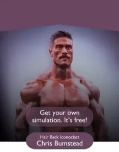 Chris Bumstead after hair transplant