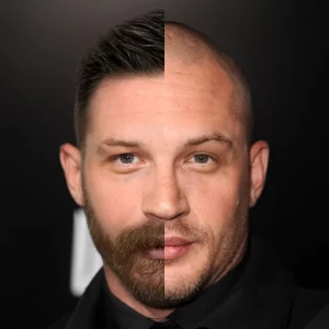 Tom Hardy HAIR TRANSPLANT RESULT