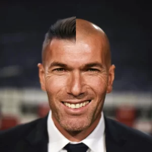 Zinedine Zidane Hair Transplant Simulation